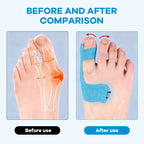 Aelln Bunion Relief Toe Correction Wrap
